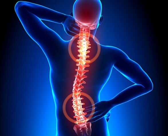 osteokondrozlu omurgada ağrı