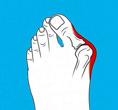 ayak parmağındaki eklemin artrozu