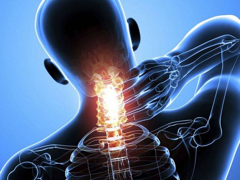 Servikal omurganın osteokondrozuna boyunda ağrı eşlik eder