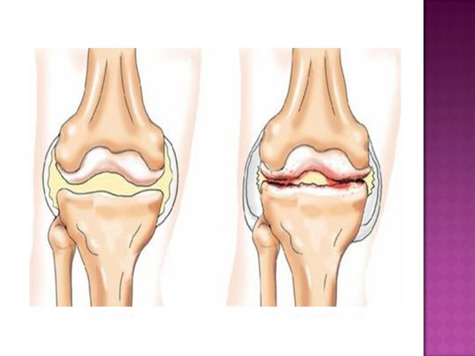 Eklem normaldir (solda) ve osteoartritten etkilenir (sağda)