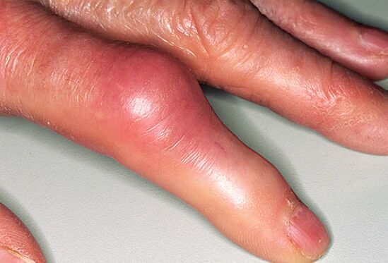 Guta, parmaklarda keskin ağrı ve eklemlerin şişmesi eşlik eder. 