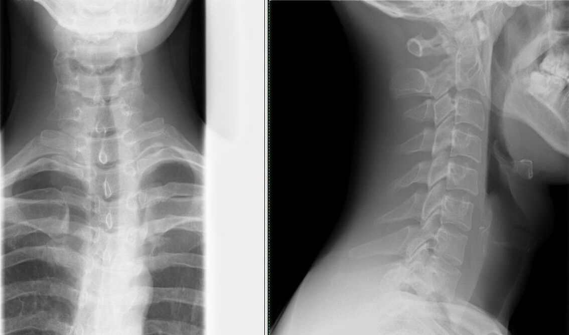 Omurganın röntgeni osteokondroz tanısı için basit ve etkili bir yöntemdir